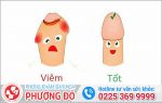 Dấu hiệu nhận biết viêm bao quy đầu nam giới cần biết?