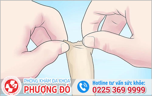 Cách nong bao quy đầu cho nam giới