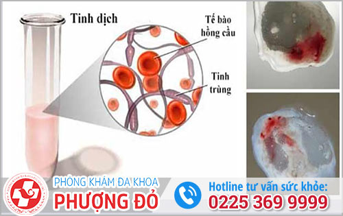 Giãn mạch thừng tinh là biến chứng nguy hiểm gây xuất tinh ra máu 