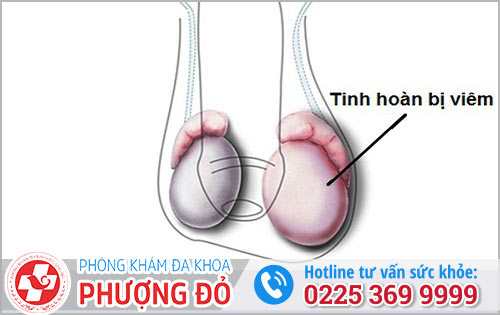 Viêm tinh hoàn và những điều nam giới cần biết